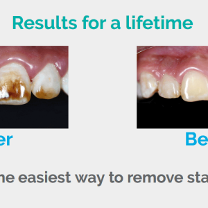 Before and After
