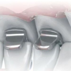 Morelli Ortho Stop Bite Guide 2
